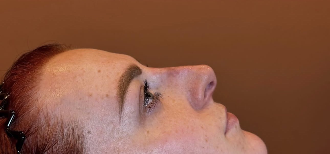 Nose after non-surgical rhinoplasty